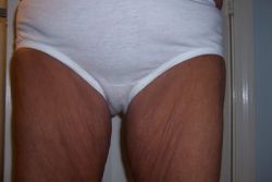 Tôi cần căng da đùi trong qua đường rạch ở vị trí nào?