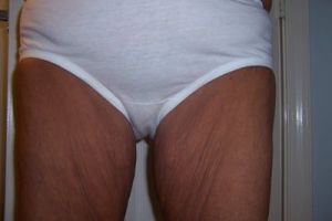 Tôi cần căng da đùi trong qua đường rạch ở vị trí nào?