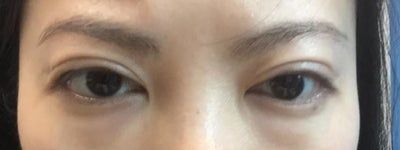 Sẹo lan rộng sau phẫu thuật tạo mắt hai mí, có phải do loại bỏ quá nhiều mỡ không?