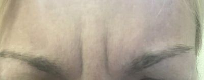 50 unit botox nep cau may1