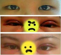 14 ngày sau cắt mí kết hợp mở góc mắt trong, hai bên mắt quá gần nhau?