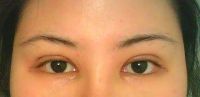 14 ngày sau cắt mí kết hợp mở góc mắt trong, hai bên mắt quá gần nhau?