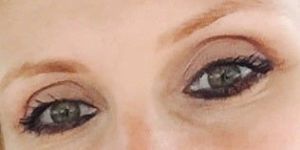 Hốc mắt bị trũng sâu, làm thế nào để chỉnh sửa mí mắt trên?