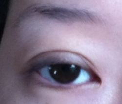 Bị sẹo và thừa nếp gấp da sau khi tạo mắt hai mí với đường rạch 1 phần, có cần chỉnh sửa không?