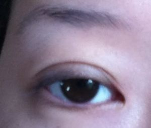 Bị sẹo và thừa nếp gấp da sau khi tạo mắt hai mí với đường rạch 1 phần, có cần chỉnh sửa không?