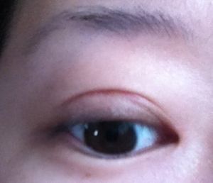 Bị sẹo và thừa nếp gấp da sau khi tạo mắt hai mí với đường rạch 1 phần, có cần chỉnh sửa không?