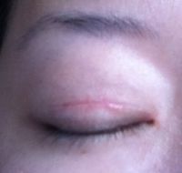 Bị sẹo và thừa nếp gấp da sau khi tạo mắt hai mí với đường rạch 1 phần, có cần chỉnh sửa không?