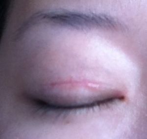 Bị sẹo và thừa nếp gấp da sau khi tạo mắt hai mí với đường rạch 1 phần, có cần chỉnh sửa không?