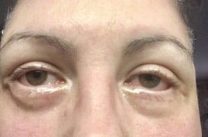 Làm gì khi mí dưới bị co rút, sưng và hơi lật mí sau phẫu thuật cắt mí dưới