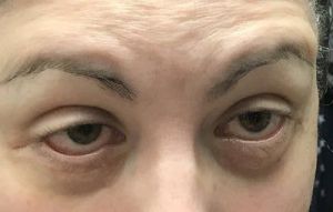 Làm gì khi mí dưới bị co rút, sưng và hơi lật mí sau phẫu thuật cắt mí dưới