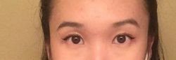 Mí mắt hai bên không đều do chỉnh sửa mí mắt khi hai bên lông mày không cân nhau