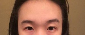 Mí mắt hai bên không đều do chỉnh sửa mí mắt khi hai bên lông mày không cân nhau