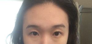 Mí mắt hai bên không đều do chỉnh sửa mí mắt khi hai bên lông mày không cân nhau