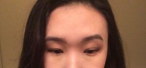 Mí mắt hai bên không đều do chỉnh sửa mí mắt khi hai bên lông mày không cân nhau