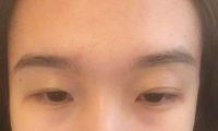 Mí mắt hai bên không đều do chỉnh sửa mí mắt khi hai bên lông mày không cân nhau