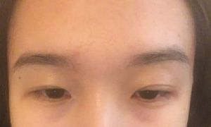 Mí mắt hai bên không đều do chỉnh sửa mí mắt khi hai bên lông mày không cân nhau
