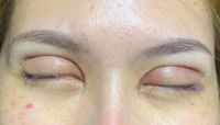 Cắt mí xong bị hở mi, không nhắm kín được mắt
