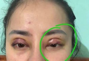 Cắt mí được 4 ngày như này có phải bị lật mi không?