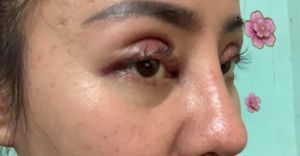 Cắt mí được 4 ngày như này có phải bị lật mi không?