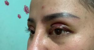 Cắt mí được 4 ngày như này có phải bị lật mi không?