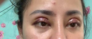 Cắt mí được 4 ngày như này có phải bị lật mi không?