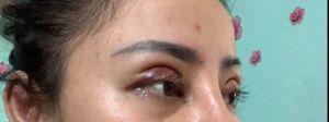 Cắt mí được 4 ngày như này có phải bị lật mi không?
