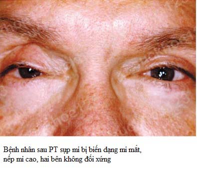 biến chứng sụp mí biến dạng mí mắt