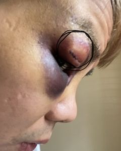 Cắt mí mắt xong bị thâm tím
Và nổi cục có sao không?