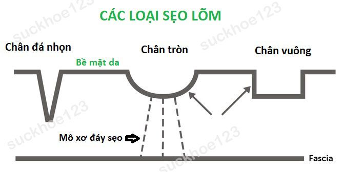 cac loai seo lom