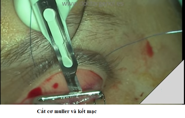 kẹp cơ muller2