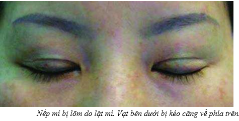 lật mi