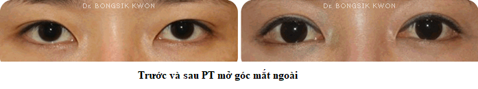 mo goc m ngoai 2