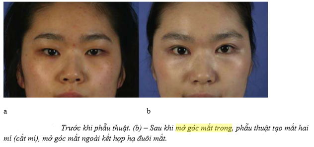 mở góc mắt ngoài kết hợp hạ đuôi mắt