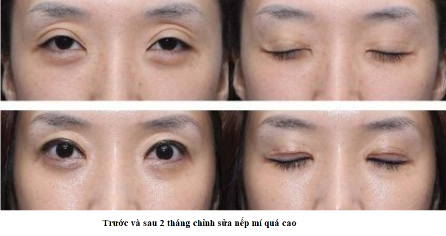 nếp mí quá cao 3