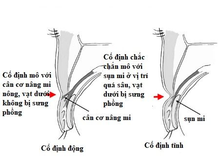nếp mí sưng phồng 4