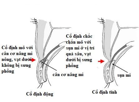 nếp mí sưng phồng 4