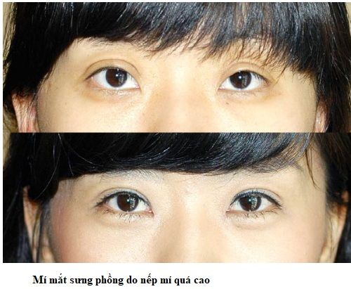 nếp mí sưng phồng 5