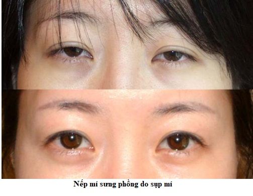 nếp mí sưng phồng 6