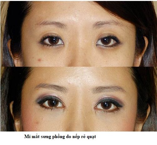 nếp mí sưng phồng 7