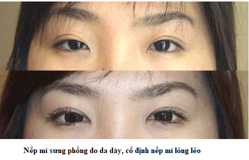 nếp mí sưng phồng 8