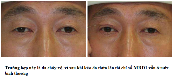 phân biệt sụp mí da chảy xệ 1