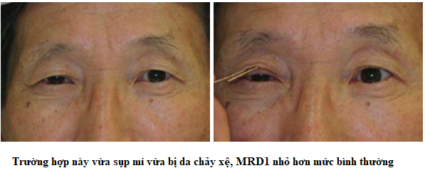 phân biệt sụp mí da chảy xệ 2
