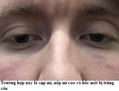 phân biệt sụp mí da chảy xệ 3