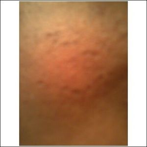 Isotretinoin chữa hết mụn nhưng để lại sẹo