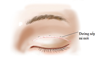 sửa nếp mí thấp 2