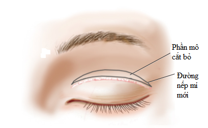 sửa nếp mí thấp 3