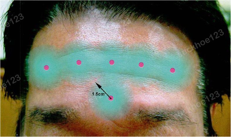 tiem botox cach xa long may