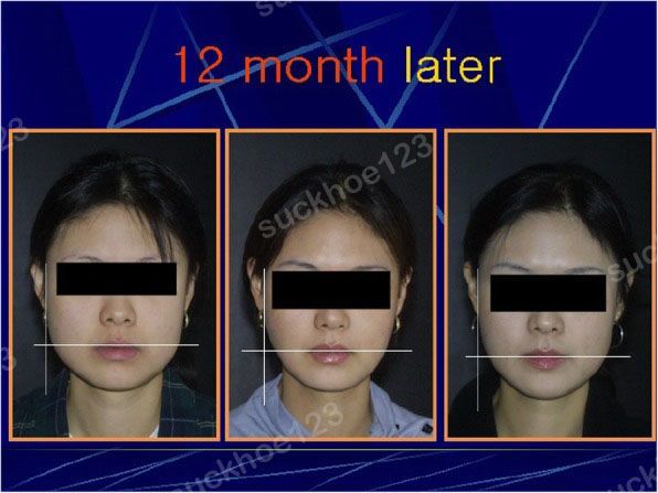 tiem botox ham banh1