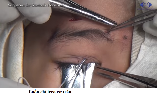 treo cơ trán 2