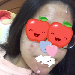 Làm sao để trị mụn và trị thâm